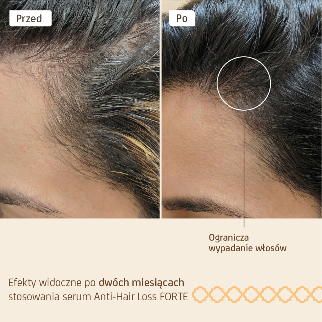 Anti – Hair loss forte